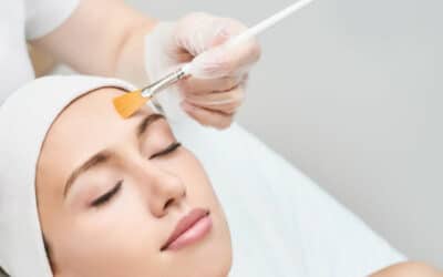 Can Chemical Peels Effectively Treat Melasma?
