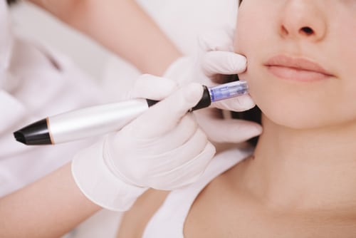 Microneedling for Rosacea: A Promising Treatment Option?