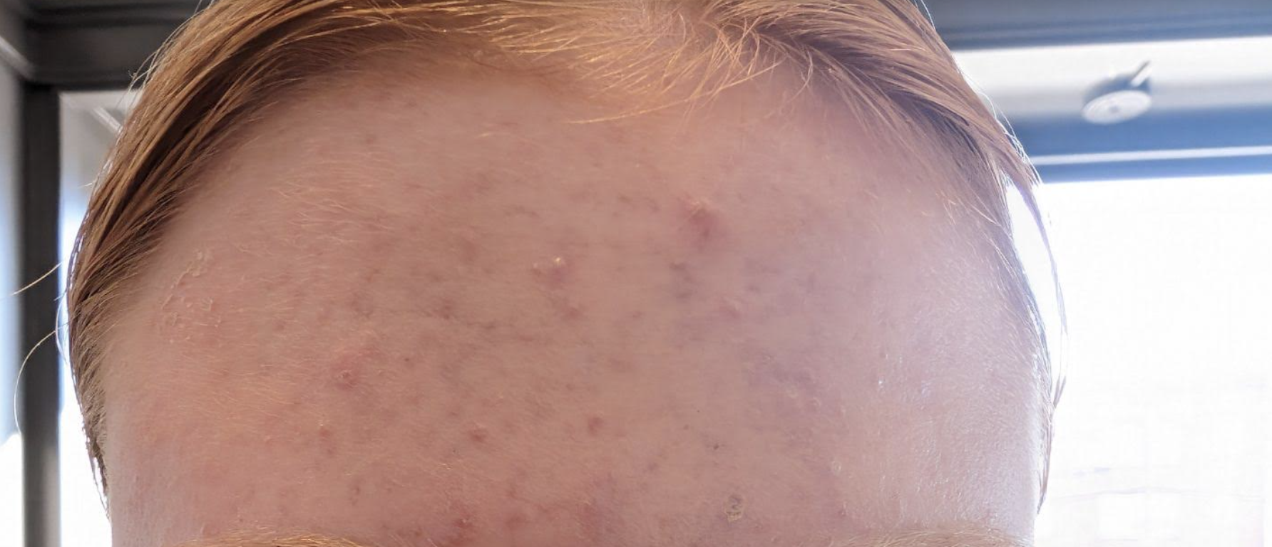 post chemical peel acne treatment